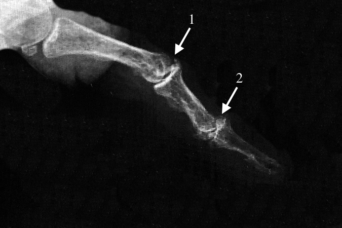 PIP joint severe OA (1) and DIP joint OA (2).