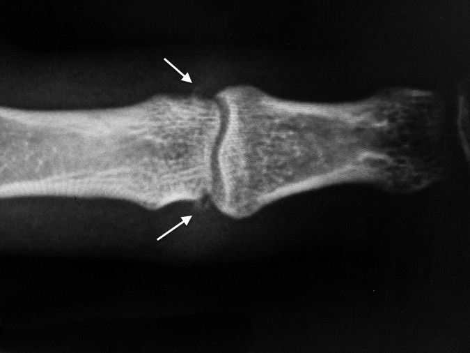 X-ray of PIP joint sprain. Note tiny collateral avulsion fractures (arrows) and soft tissue swelling around the PIP joint.