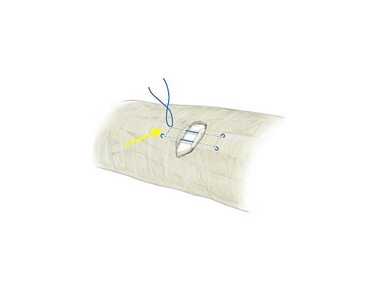 A Doyle style modified Kessler style core suture for extensor tendon repair around the dorsal PIP joint area.  A 3-O or 4-O  braided synthetic permanent suture is one acceptable suture  choice for the the core suture which is place in the extensor tendon proximally and in the central slip (arrow) distally.