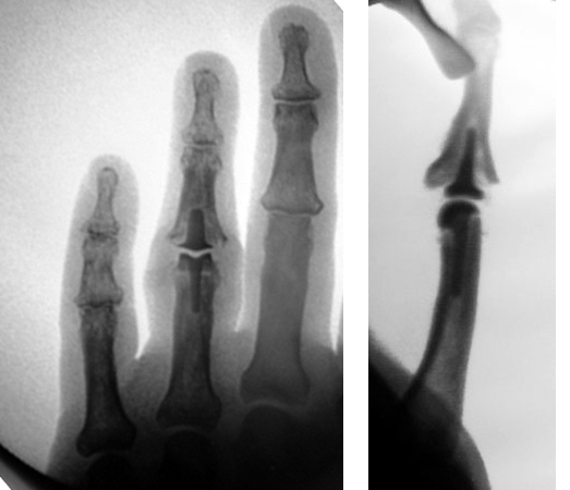 PIP joint pyrocarbon arthroplasty final X-ray.