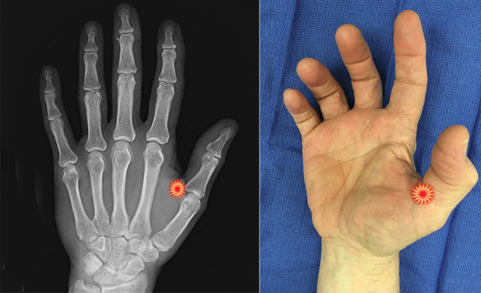 The red "tender" sign pin points the area of tenderness in relationship to the metacarpal, phalanx, MP joint and the surface anatomy of a patient with a trigger thumb.