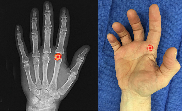 The red "tender" sign pin points the area of tenderness in relationship to the metacarpal, phalanx, MP joint and the surface anatomy of a patient with a index trigger finger.