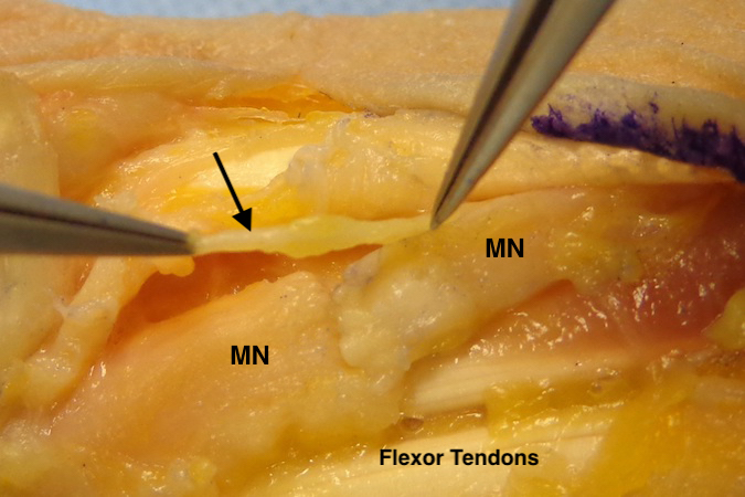 Palmar cutaneous branch (arrow) of the Median Nerve (MN) with underlying tendons.