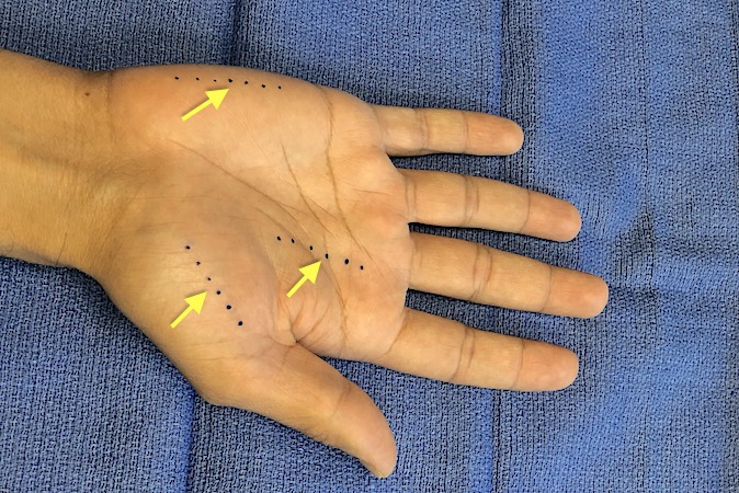 Incisions for palmar hand compartment releases