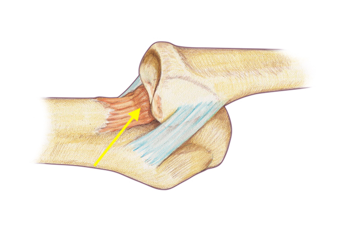 Dorsal view of complex dorsal MP dislocation.