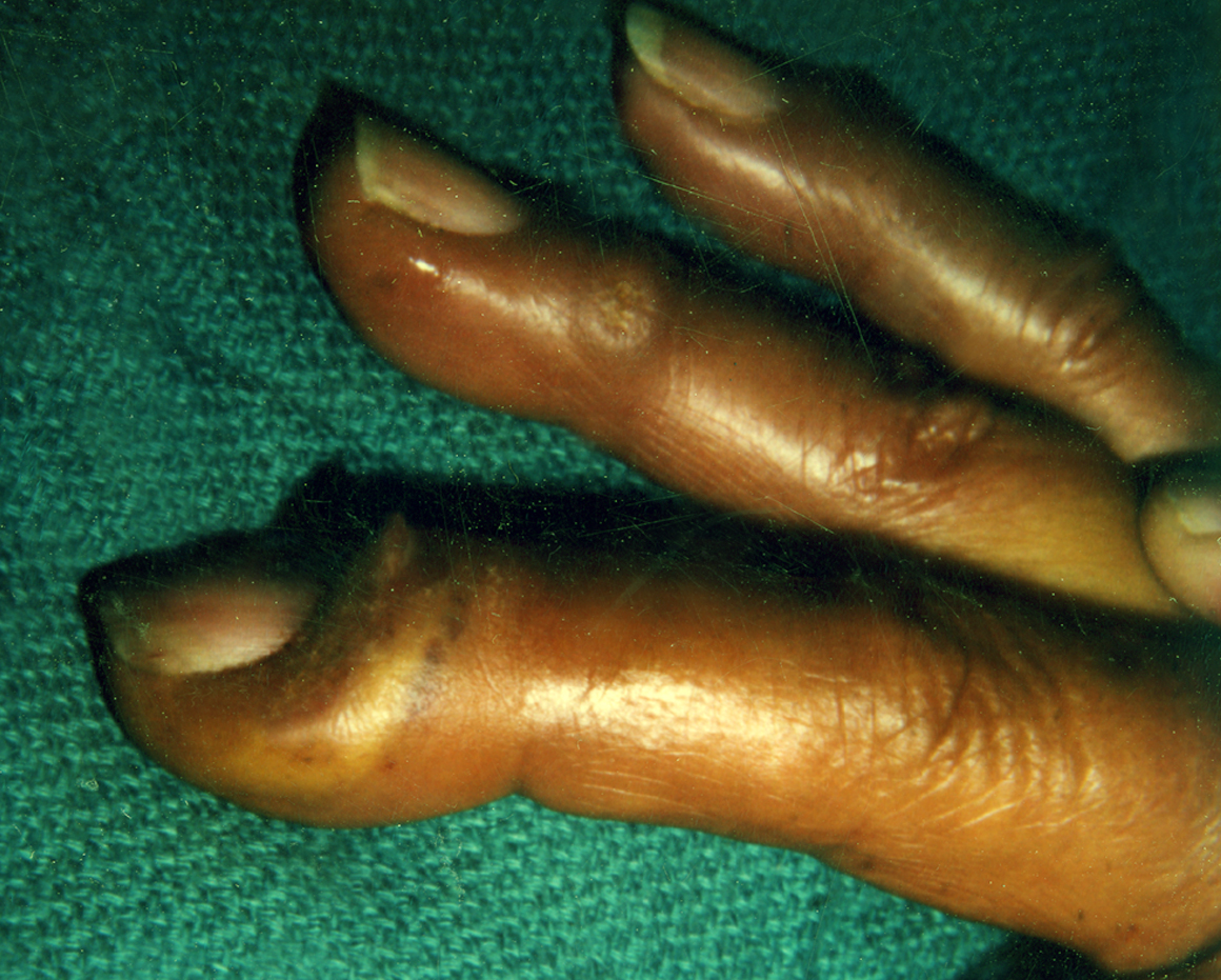 Paronychia right index finger