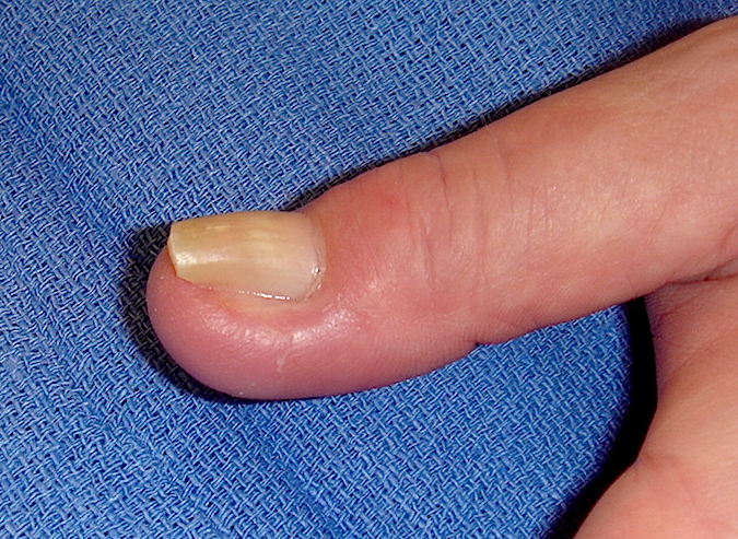 Early paronychia with previous nail damage