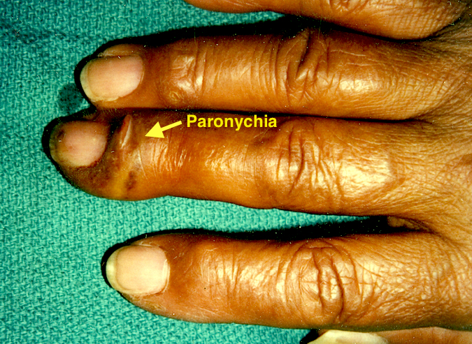 Paronychia Long Finger