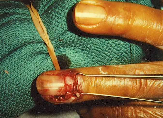 Paronychia Long Finger after I&D of nail fold and excision of proximal nail