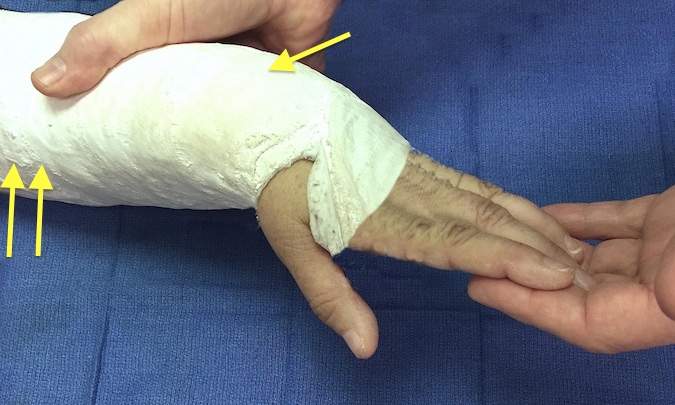 Passive extension of fingers creates stretching of the left flexor muscles (double arrow). If the muscle is ischemic stretching causes severe pain. Pain in area of distal radius fracture (single arrow) is related to fracture tenderness not ischemia secondary to compartment syndrome.