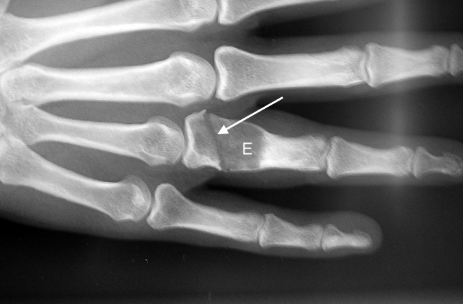 Nondisplaced pathologic fracture (AP view) of the right ring finger proximal phalanx (arrow) secondary to an expanding enchondroma (E).
