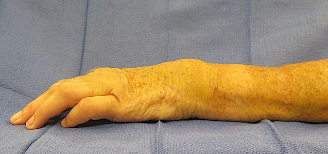 Silver fork deformity in young patient with an untreated partially healed distal radius fracture