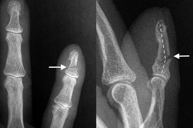 Distal phalanx shaft fracture (arrow) AP & Lat with dorsal apex angulation