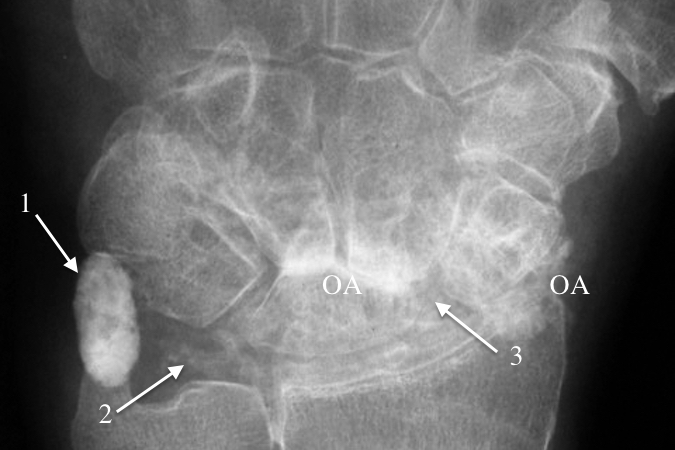 Left wrist with pseudo-gout and SLAC arthritis.  Note CPPD crystals (1) that are forming a tumor-like mass around the FCU tendon, calcification of the TFCC (2), and S-L gap (3) secondary to chronic ligament tear with arthritis (OA)in mid-carpal joint and radioscaphoid joint.