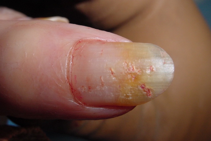 Fingere Nail Pitting Secondary to Psoriasis