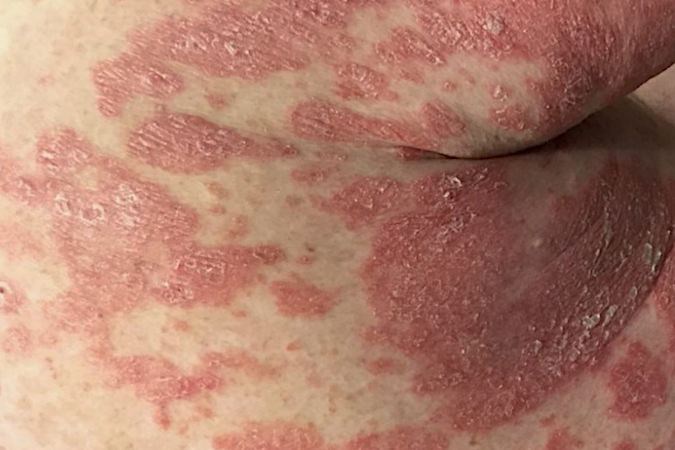 Psoriasis of the posterior upper arm and posterior right chest