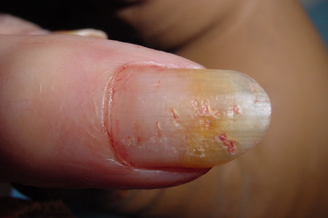 Psoriatic arthritis - Fingernail changes