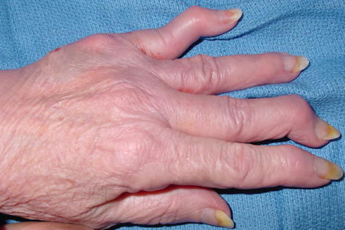 Psoriatic arthritis - Noted marked DIP joint deformities