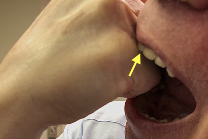 Punch to the upper jaw. Incisor (arrow) about to cut skin, extensor tendon and MP joint capsule.