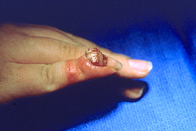 Pyogenic granuloma at the base of the right fifth finger in a 39 y.o. female