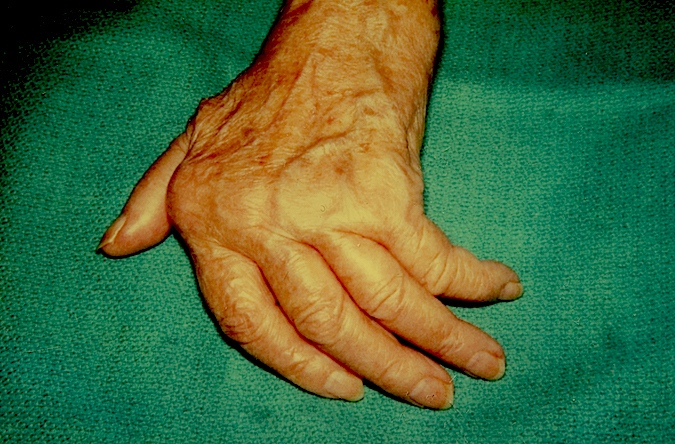 Classic Rheumatoid right hand with ulnar drift of fingers and subluxed MP joints