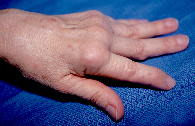 Classic Rheumatoid right hand with ulnar drift of fingers, subluxed MP joints with synovitis