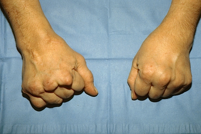 Classic Rheumatoid right hand with destroyed right MP joints