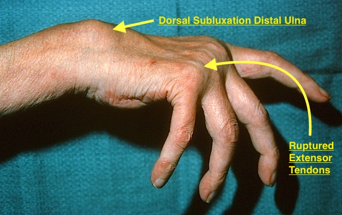 Rheumatoid hand and wrist subluxed distal ulna and ruptured extensor tendons