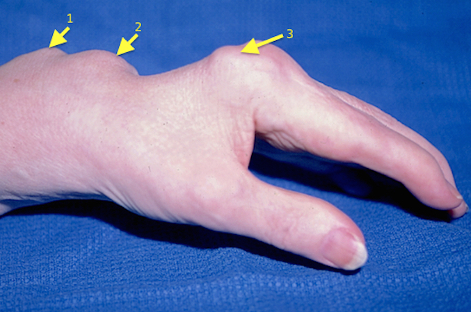 Synovitis MP joints (3); tenosynovitis (2); and subluxed distal ulna (1).