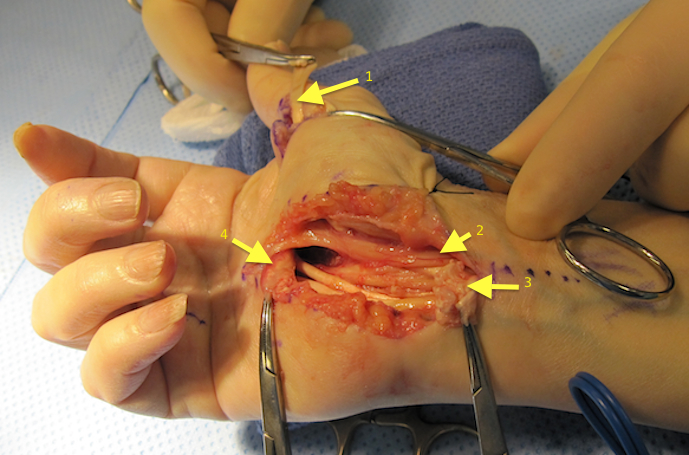 RA: FPL and FDP II Ruptures: (1) Transfer FDS IV to replace FPL, (2) Median Nerve, (3&4) Ruptured flexor tendons