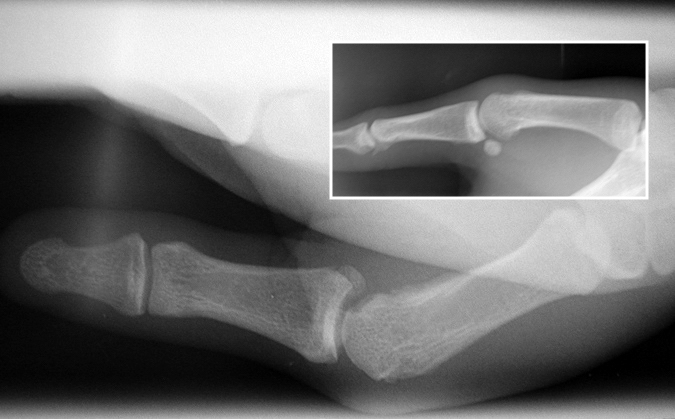Radial collateral ligament stress X-ray.  Note normal lateral view (insert).