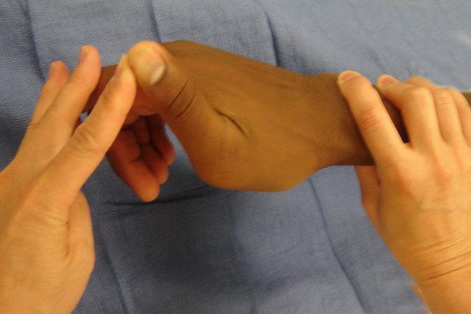 A 27 year old male who injuried this right thumb two months ago in a basketball game.  He did not seek treatment but now complaining of right thumb instability and pain. Stress test of the radial collateral ligament shown.