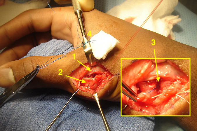 Right thumb MP joint  showing dorsal MP joint capsule (1); radial collateral ligament  with pullout blue suture and repair suture in place (2 );   Hole in metacarpal head (3) for passing pullout suture which exits dorsal ulnarly (4).