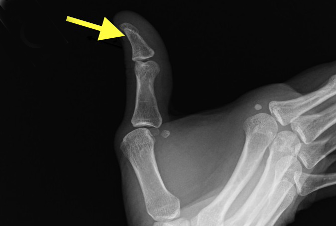 Stress X-ray - Radial Collateral of Thumb MP Stress View