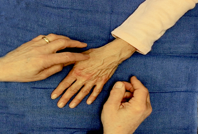 Radial nerve sensation being tested radial dorsal hand (dorsal first web).