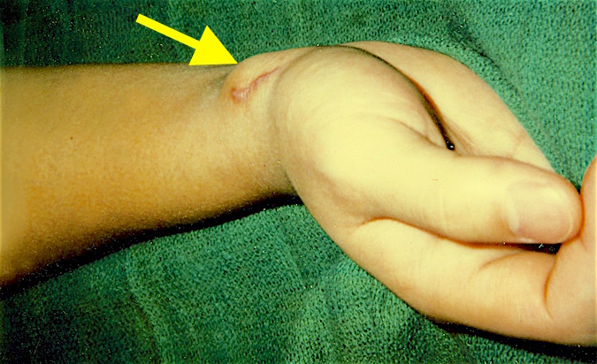 Radial artery pseudoaneurysm (arrow) after what was thought to be a superficial laceration that was closed in the emergency room.