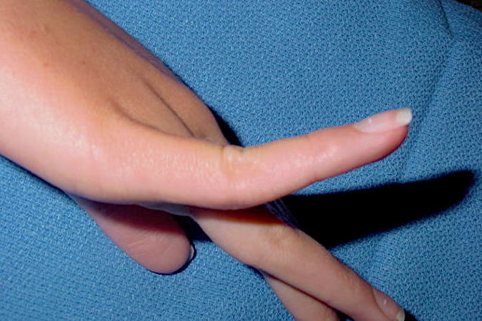  Volar plate rupture right fifth finger chronic