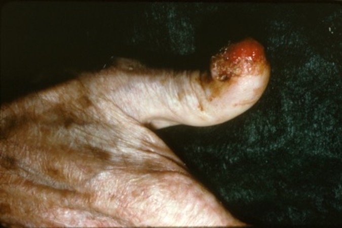 Saquamous Cell Carcinoma Right Thumb