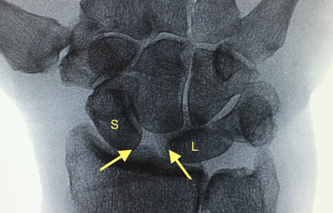 Left wrist with early SLAC changes. Note large gap between arrows and minimal OA changes. Scaphoid (S) and Lunate (L).