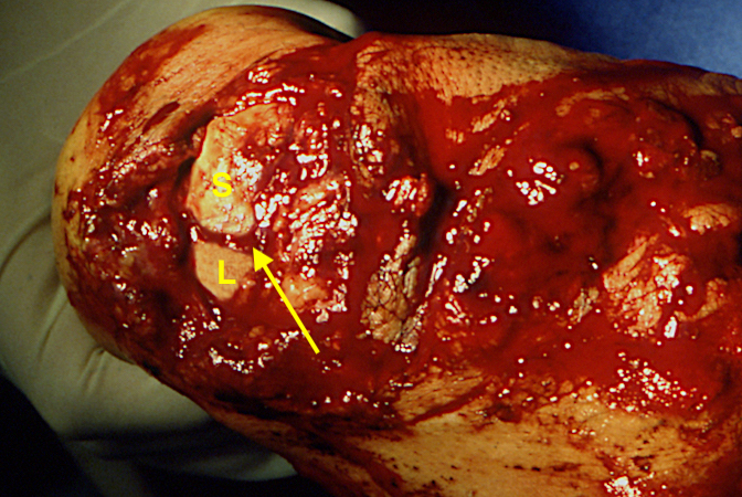 Open scapholunate acute laceration with transected the extensor tendons. Scaphoid(S); Lunate(L); Cut S-L ligament (arrow).