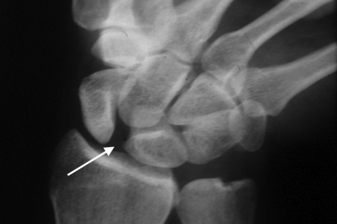 Large S-L gap (arrow) on ulnar deviated AP X-ray 4 weeks after a right wrist injury.