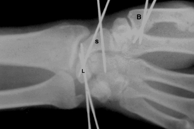 Scapholunate tear after open reduction and pinning. Scaphoid(S); Lunate(L); Bennett's fracture post ORIF with pins (B).