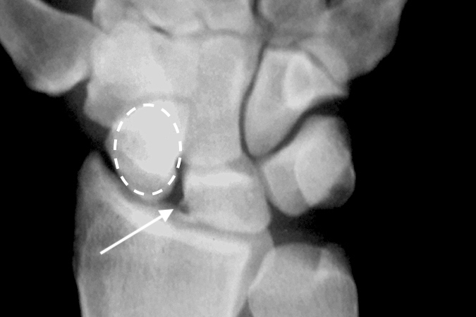S-L gap (arrow) on neutral AP X-ray  after a right wrist injury.  Note vertical position of the scaphoid , "signet ring sign" ( dashed oval).