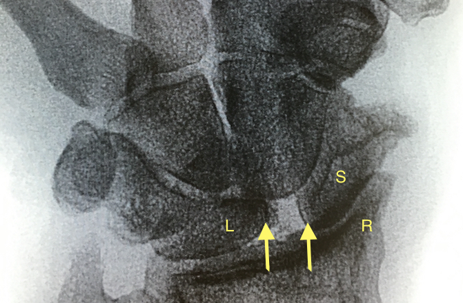 Right wrist with severe SLAC changes. Note large gap between arrows and marked OA changes. Scaphoid (S), Radius (R) and Lunate (L).