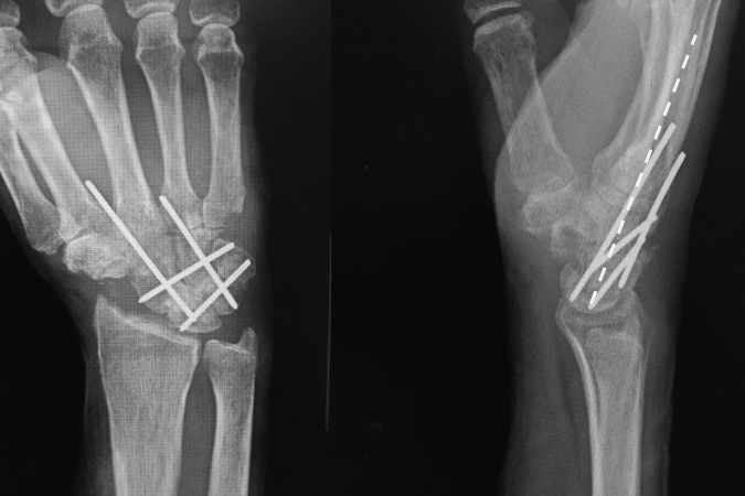 Scaphoid excised, bone graft in place and fusion secured with four "65" K-wires which will be removed at 6-8 weeks.