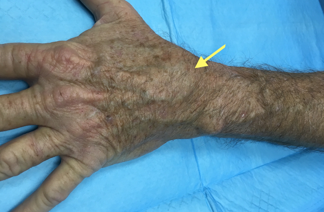 Left wrist with scapholunate advanced collapse (SLAC) osteoarthritis. Note slight swelling in the area of the scaphoid.