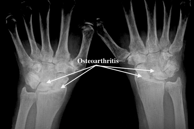 Patient with bilateral SLAC wrists with degenerative changes in radioscaphoid and capitate-lunate joints.