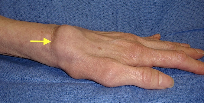 SLAC Wrist lateral view with dorsal radial synovitis (see arrow)