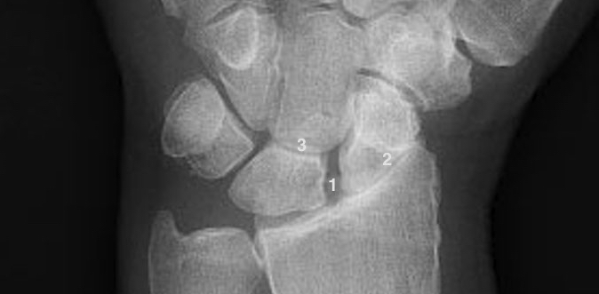 SLAC Wrist with S-L gap(1), OA radioscaphoid joint(2),&OA Lunocapitate joint(3)