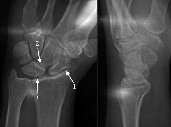 SLAC Wrist with radioscaphoid joint narrowing and osteophyte at 1 with normal cartilage at 2 and 3